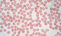 Erthrocytes (blood cells) captured under a hematology microscope. Erthrocytes (blood cells) captured under a hematology microscope.
